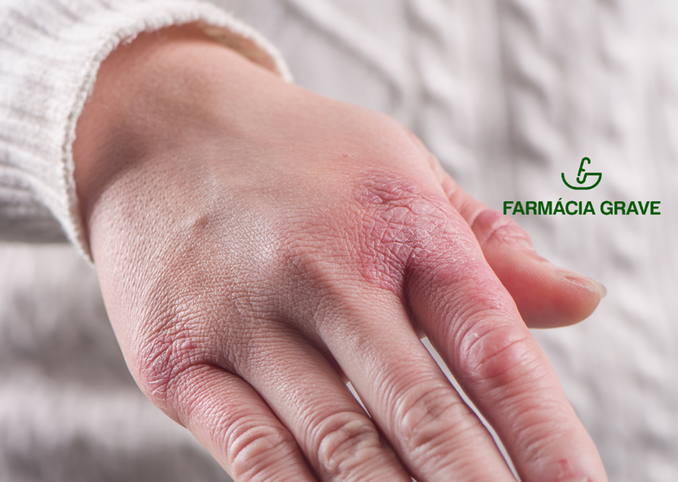 Frieiras: aprenda a prevenir!